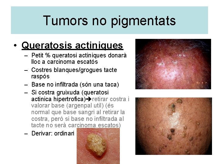 Tumors no pigmentats • Queratosis actiniques – Petit % queratosi actiniques donarà lloc a