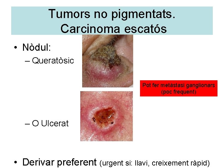 Tumors no pigmentats. Carcinoma escatós • Nòdul: – Queratòsic Pot fer metàstasi ganglionars (poc