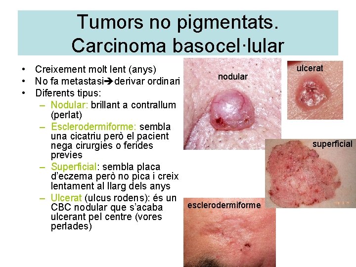 Tumors no pigmentats. Carcinoma basocel·lular • Creixement molt lent (anys) nodular • No fa