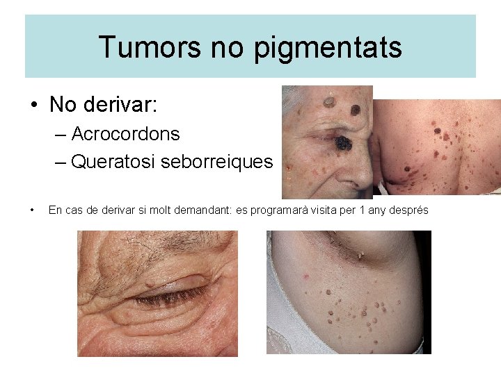 Tumors no pigmentats • No derivar: – Acrocordons – Queratosi seborreiques • En cas