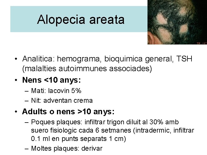 Alopecia areata • Analitica: hemograma, bioquimica general, TSH (malalties autoimmunes associades) • Nens <10