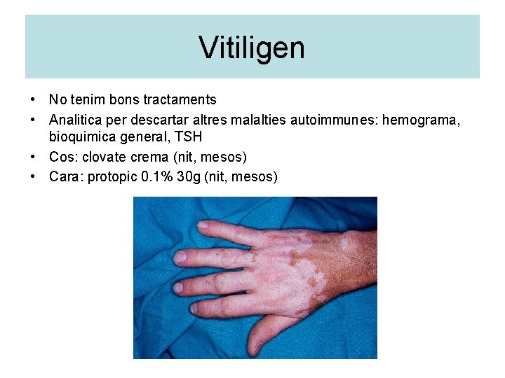 Vitiligen • No tenim bons tractaments • Analitica per descartar altres malalties autoimmunes: hemograma,