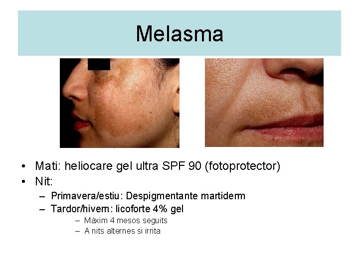 Melasma • Mati: heliocare gel ultra SPF 90 (fotoprotector) • Nit: – Primavera/estiu: Despigmentante