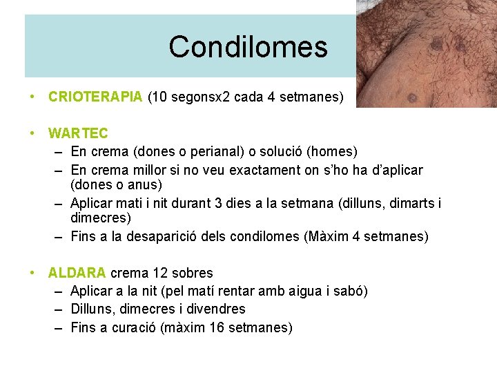 Condilomes • CRIOTERAPIA (10 segonsx 2 cada 4 setmanes) • WARTEC – En crema
