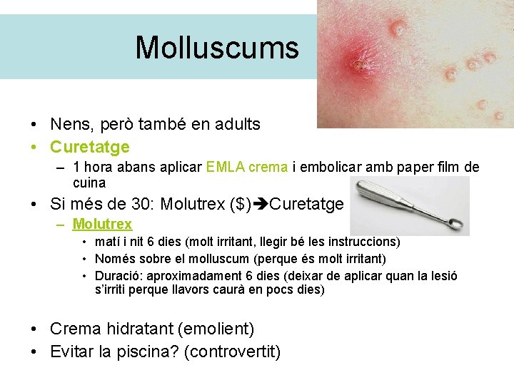 Molluscums • Nens, però també en adults • Curetatge – 1 hora abans aplicar
