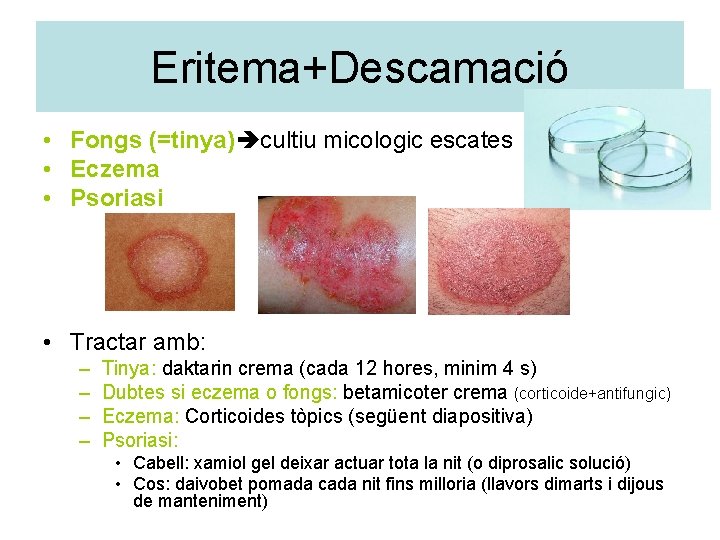 Eritema+Descamació • Fongs (=tinya) cultiu micologic escates • Eczema • Psoriasi • Tractar amb: