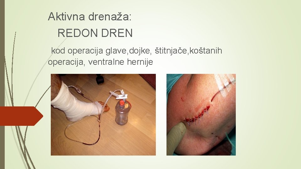 Aktivna drenaža: REDON DREN kod operacija glave, dojke, štitnjače, koštanih operacija, ventralne hernije 