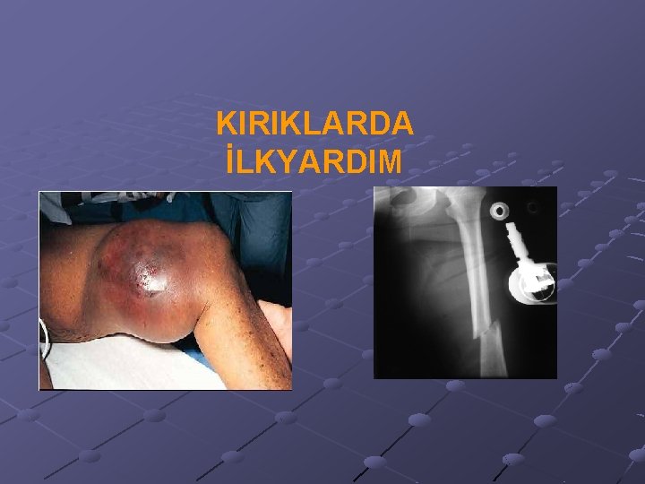 KIRIKLARDA İLKYARDIM 