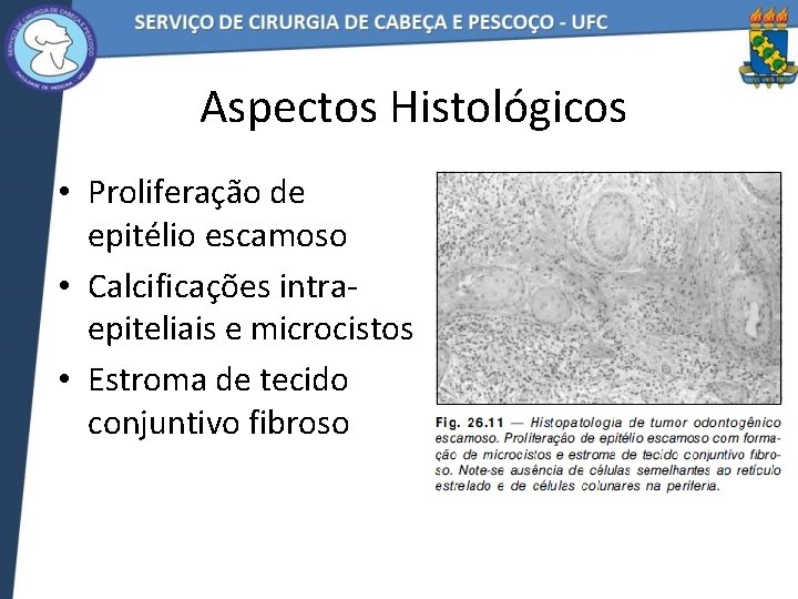 Aspectos Histológicos • Proliferação de epitélio escamoso • Calcificações intraepiteliais e microcistos • Estroma