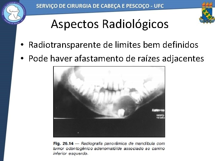 Aspectos Radiológicos • Radiotransparente de limites bem definidos • Pode haver afastamento de raízes