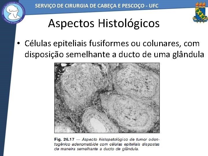 Aspectos Histológicos • Células epiteliais fusiformes ou colunares, com disposição semelhante a ducto de
