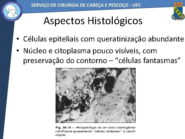 Aspectos Histológicos • Células epiteliais com queratinização abundante • Núcleo e citoplasma pouco visíveis,