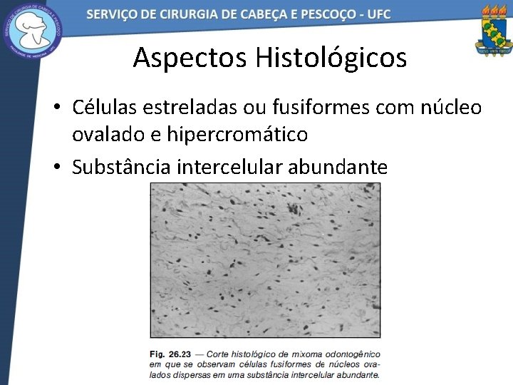 Aspectos Histológicos • Células estreladas ou fusiformes com núcleo ovalado e hipercromático • Substância