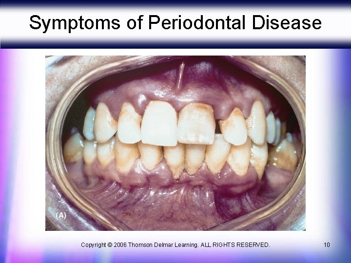 Symptoms of Periodontal Disease Copyright © 2006 Thomson Delmar Learning. ALL RIGHTS RESERVED. 10