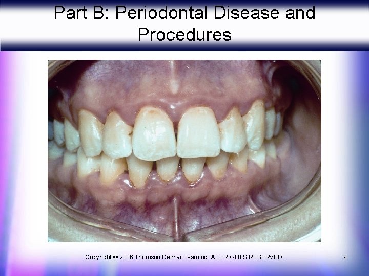 Part B: Periodontal Disease and Procedures Copyright © 2006 Thomson Delmar Learning. ALL RIGHTS