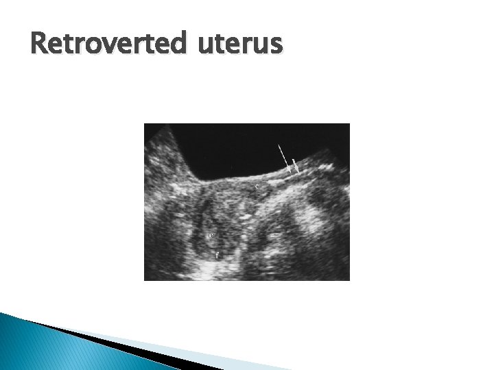 Retroverted uterus 