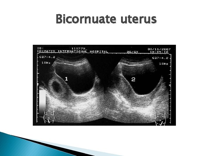 Bicornuate uterus 