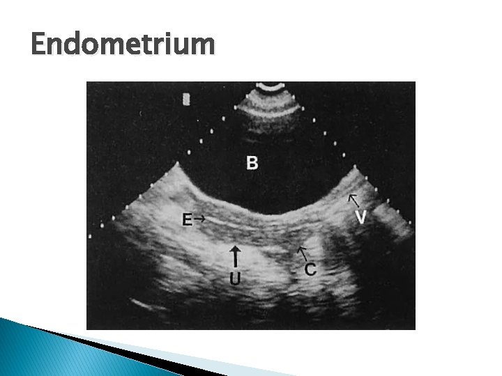 Endometrium 