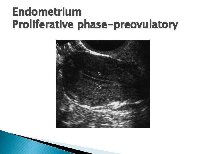 Endometrium Proliferative phase-preovulatory 