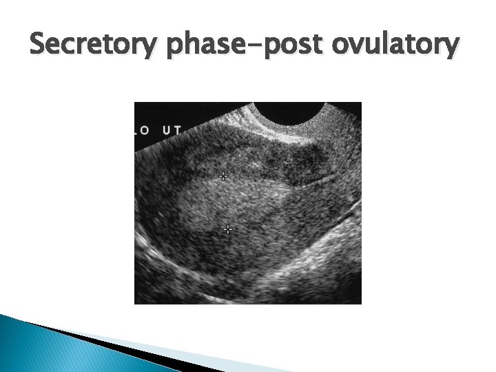 Secretory phase-post ovulatory 