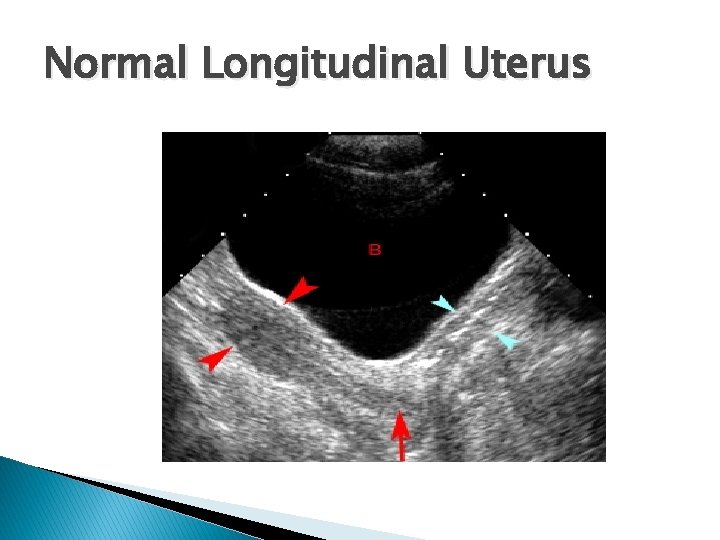 Normal Longitudinal Uterus 