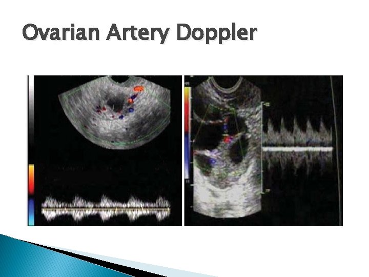 Ovarian Artery Doppler 
