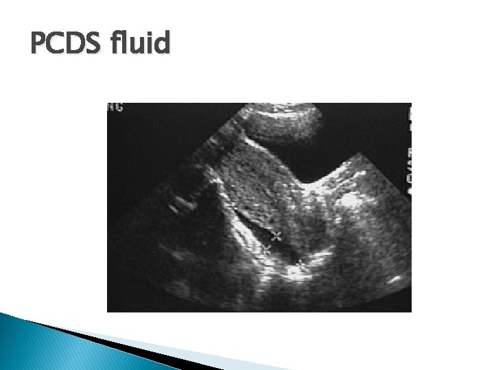 PCDS fluid 