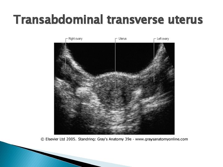 Transabdominal transverse uterus 