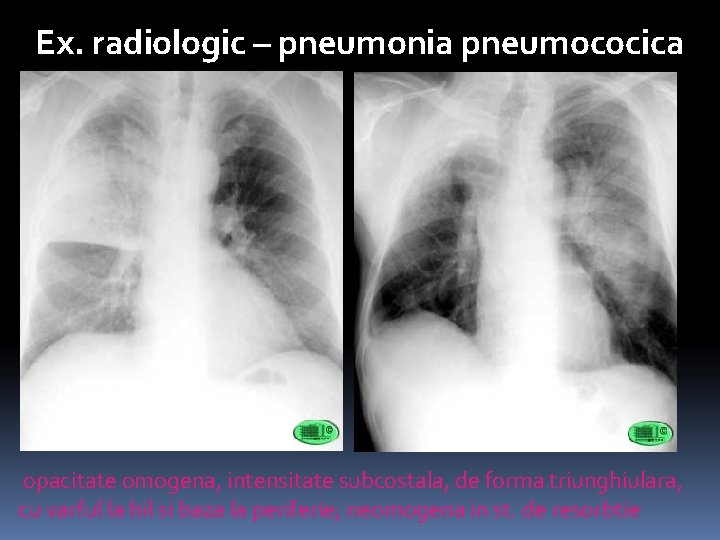 Ex. radiologic – pneumonia pneumococica opacitate omogena, intensitate subcostala, de forma triunghiulara, cu varful