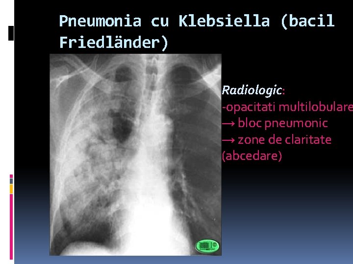 Pneumonia cu Klebsiella (bacil Friedländer) Radiologic: -opacitati multilobulare → bloc pneumonic → zone de