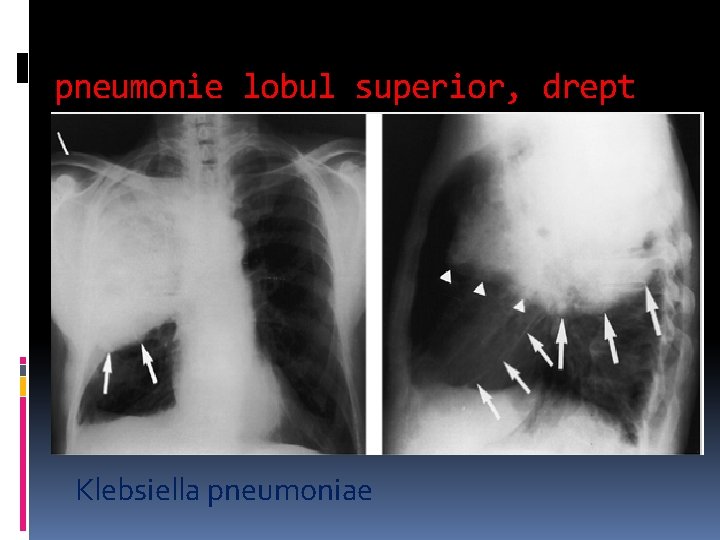 pneumonie lobul superior, drept Klebsiella pneumoniae 