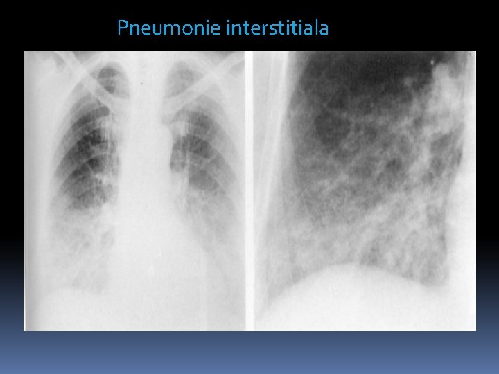 Pneumonie interstitiala 