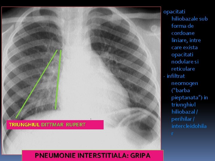 TRIUNGHIUL DITTMAR RUPERT PNEUMONIE INTERSTITIALA: GRIPA opacitati hiliobazale sub forma de cordoane liniare, intre