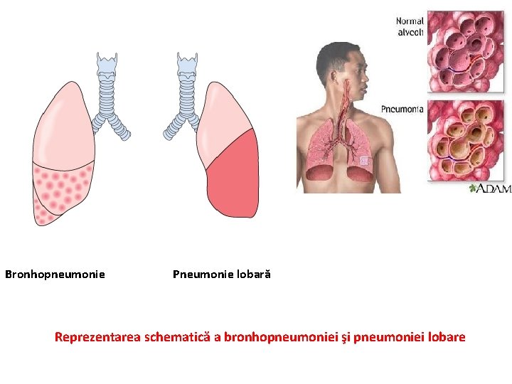 Bronhopneumonie Pneumonie lobară Reprezentarea schematică a bronhopneumoniei şi pneumoniei lobare 