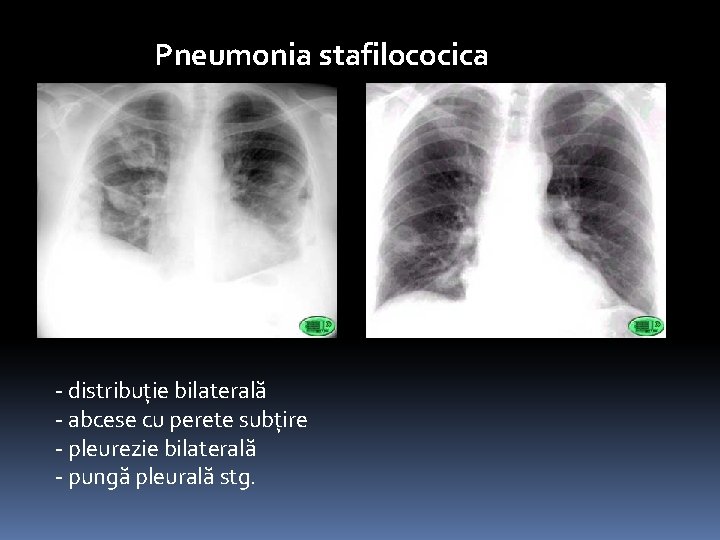 Pneumonia stafilococica - distribuţie bilaterală - abcese cu perete subţire - pleurezie bilaterală -