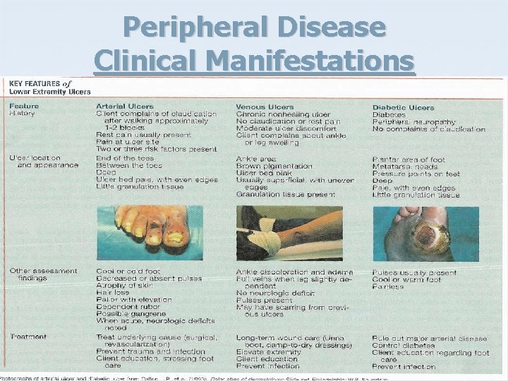 Peripheral Disease Clinical Manifestations 