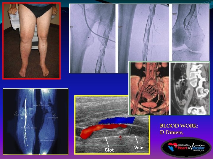 BLOOD WORK: D Dimers, 
