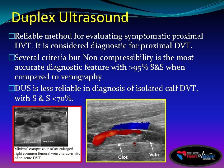 Duplex Ultrasound �Reliable method for evaluating symptomatic proximal DVT. It is considered diagnostic for