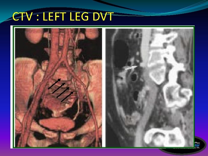 CTV : LEFT LEG DVT 