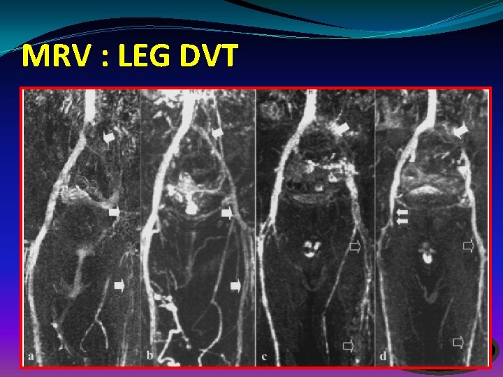 MRV : LEG DVT 