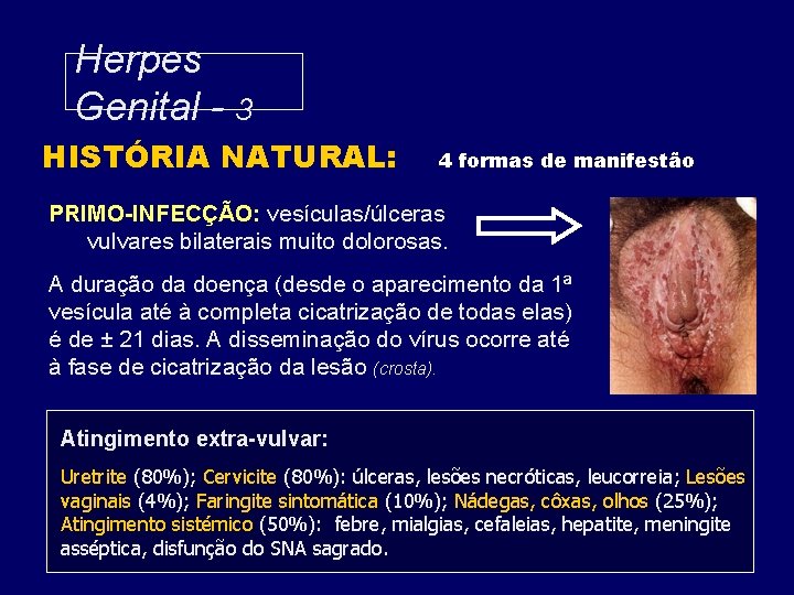 Herpes Genital - 3 HISTÓRIA NATURAL: 4 formas de manifestão PRIMO-INFECÇÃO: vesículas/úlceras vulvares bilaterais