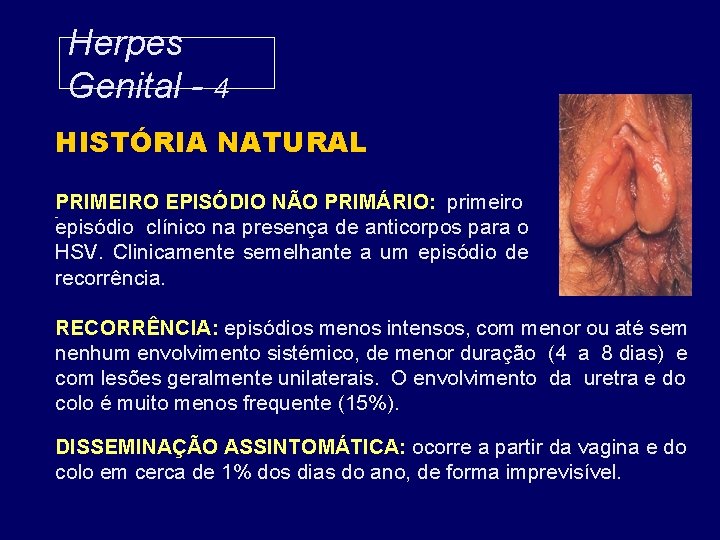 Herpes Genital - 4 HISTÓRIA NATURAL PRIMEIRO EPISÓDIO NÃO PRIMÁRIO: primeiro episódio clínico na
