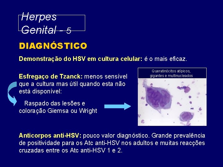 Herpes Genital - 5 DIAGNÓSTICO Demonstração do HSV em cultura celular: é o mais