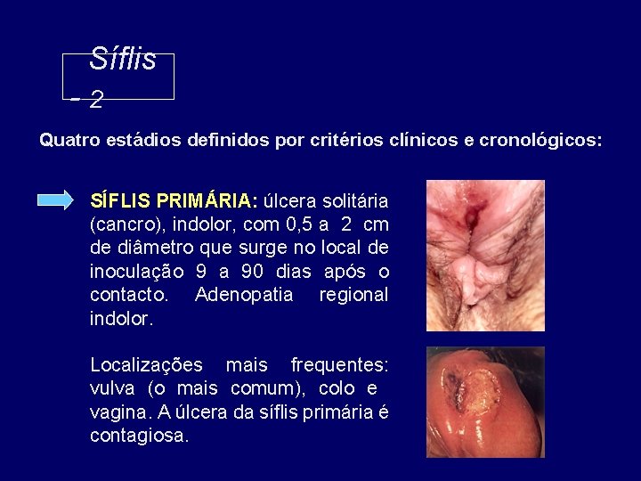 Síflis -2 Quatro estádios definidos por critérios clínicos e cronológicos: SÍFLIS PRIMÁRIA: úlcera solitária