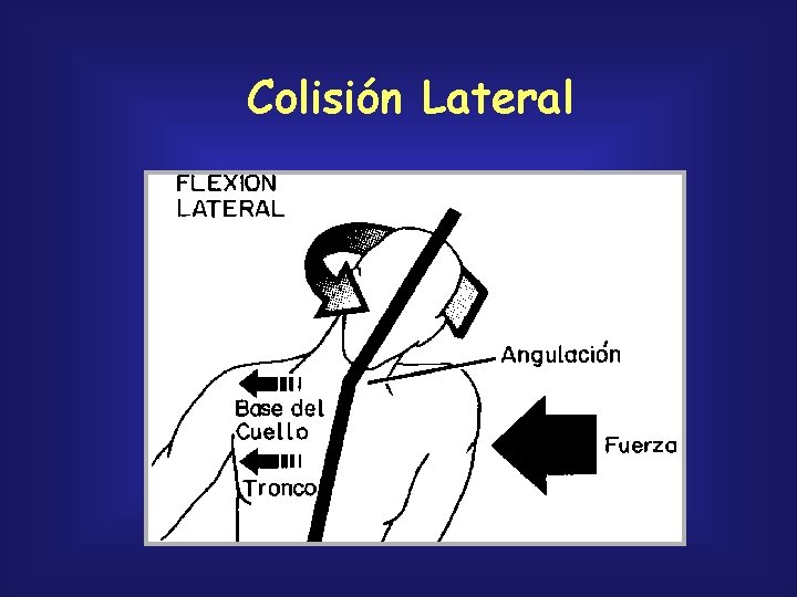 Colisión Lateral 