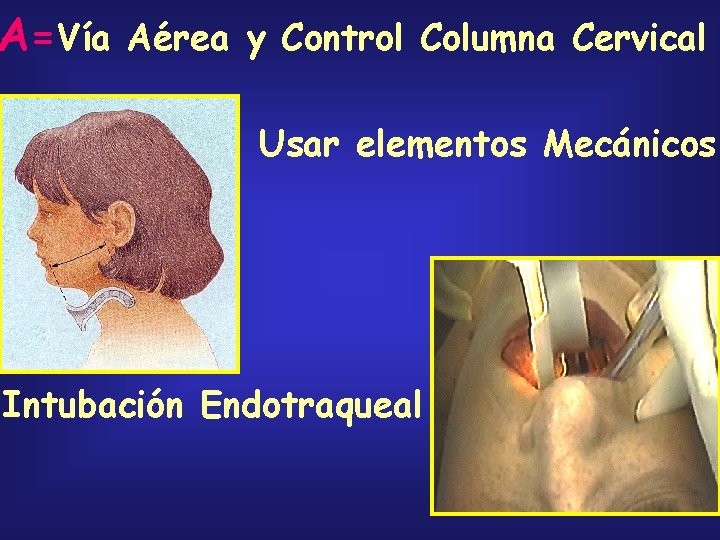 A=Vía Aérea y Control Columna Cervical Usar elementos Mecánicos Intubación Endotraqueal 