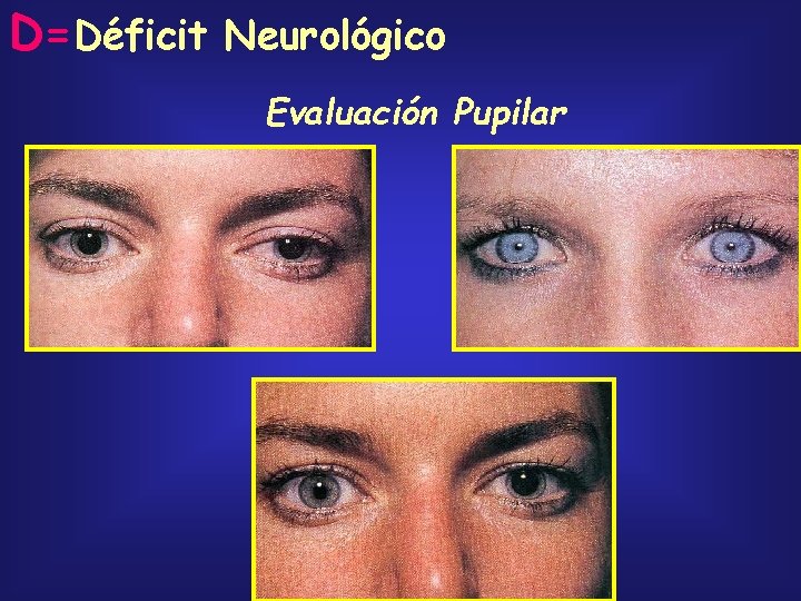 D=Déficit Neurológico Evaluación Pupilar 