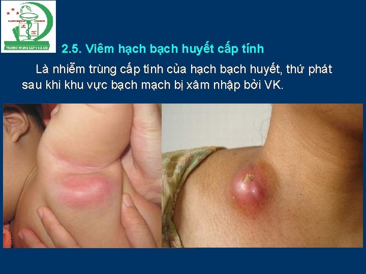 2. 5. Viêm hạch bạch huyết cấp tính Là nhiễm trùng cấp tính của