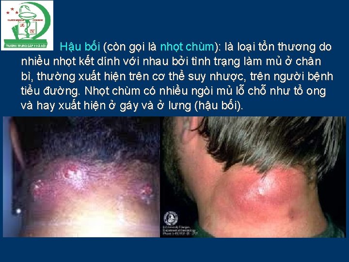 Hậu bối (còn gọi là nhọt chùm): là loại tổn thương do nhiều nhọt