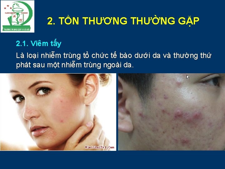 2. TỔN THƯƠNG THƯỜNG GẶP 2. 1. Viêm tấy Là loại nhiễm trùng tổ